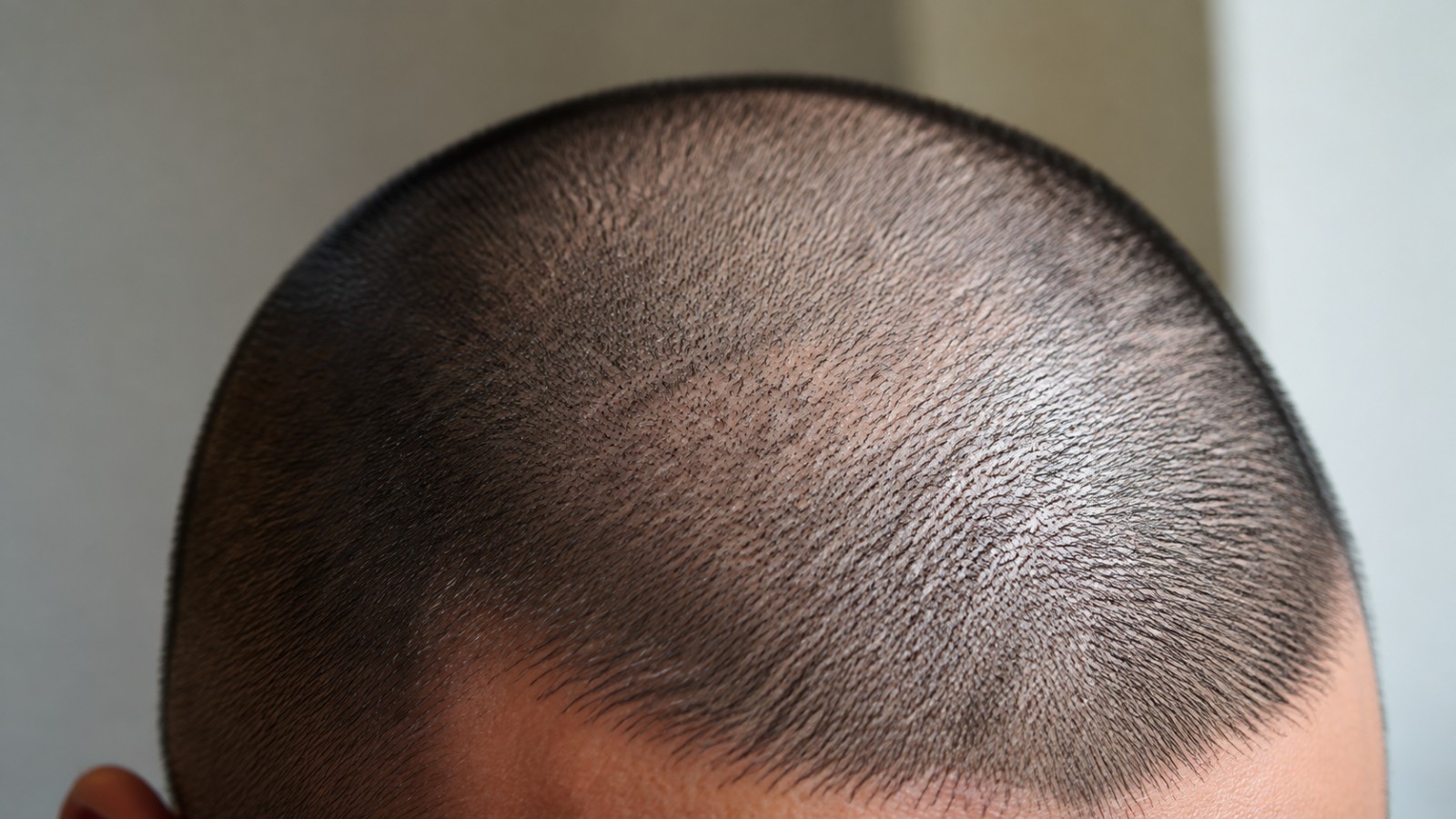 With the hair reduced to stubble, the skin of the scalp becomes fully visible and fully exposed.